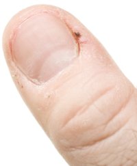 Bad Hangnail